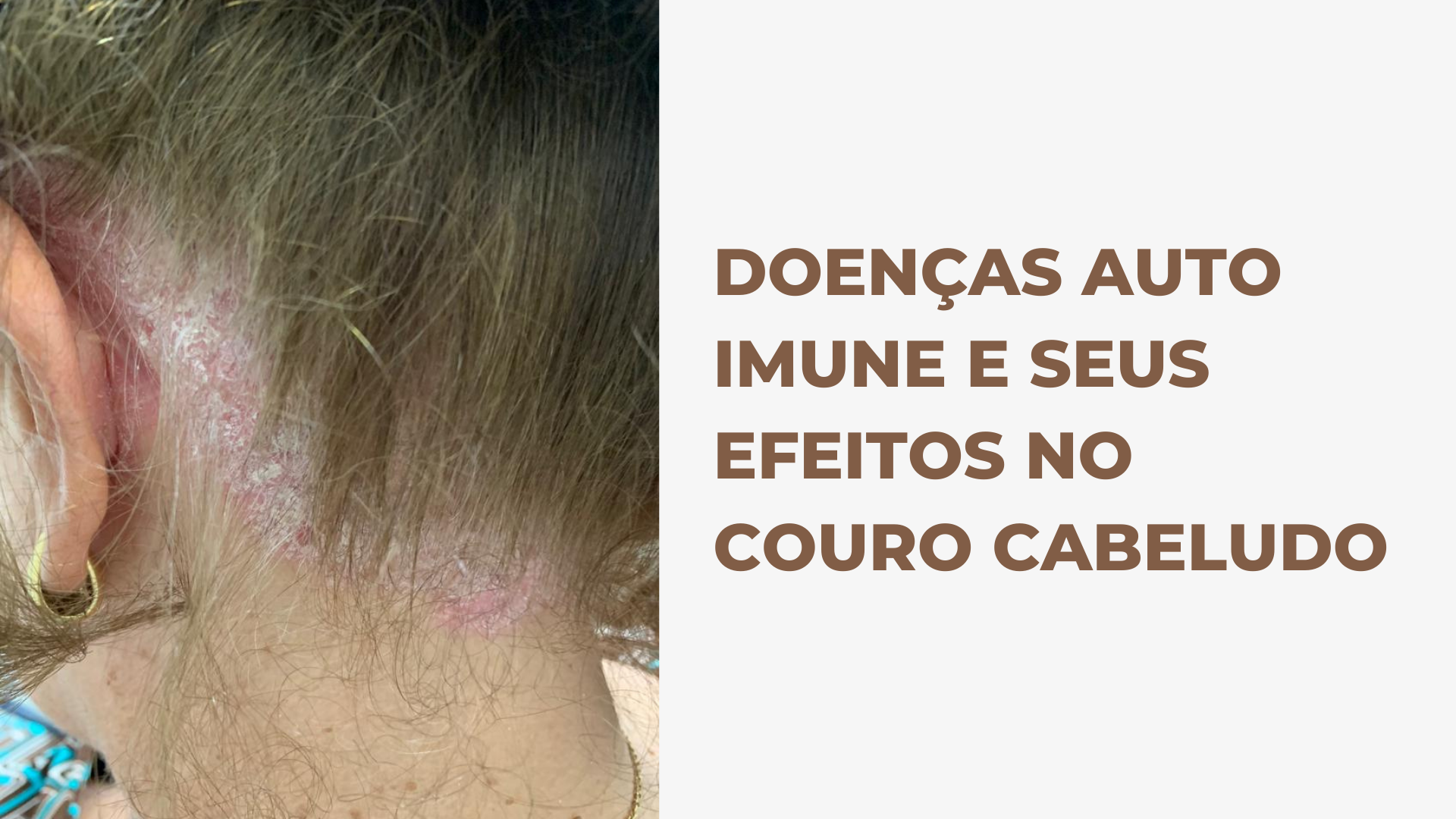  Doenças auto imune e seus efeitos no couro cabeludo.