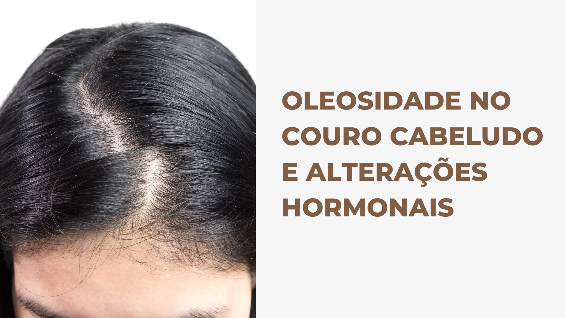 Oleosidade no couro cabeludo e alterações hormonais.